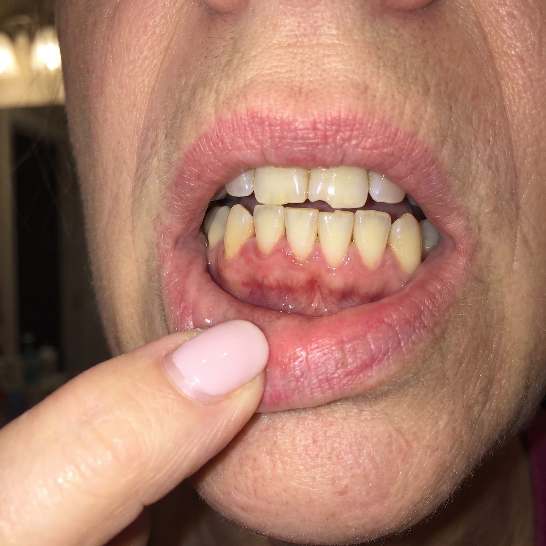 Carol's gum line on Day 30: calmer, less swollen, no blood