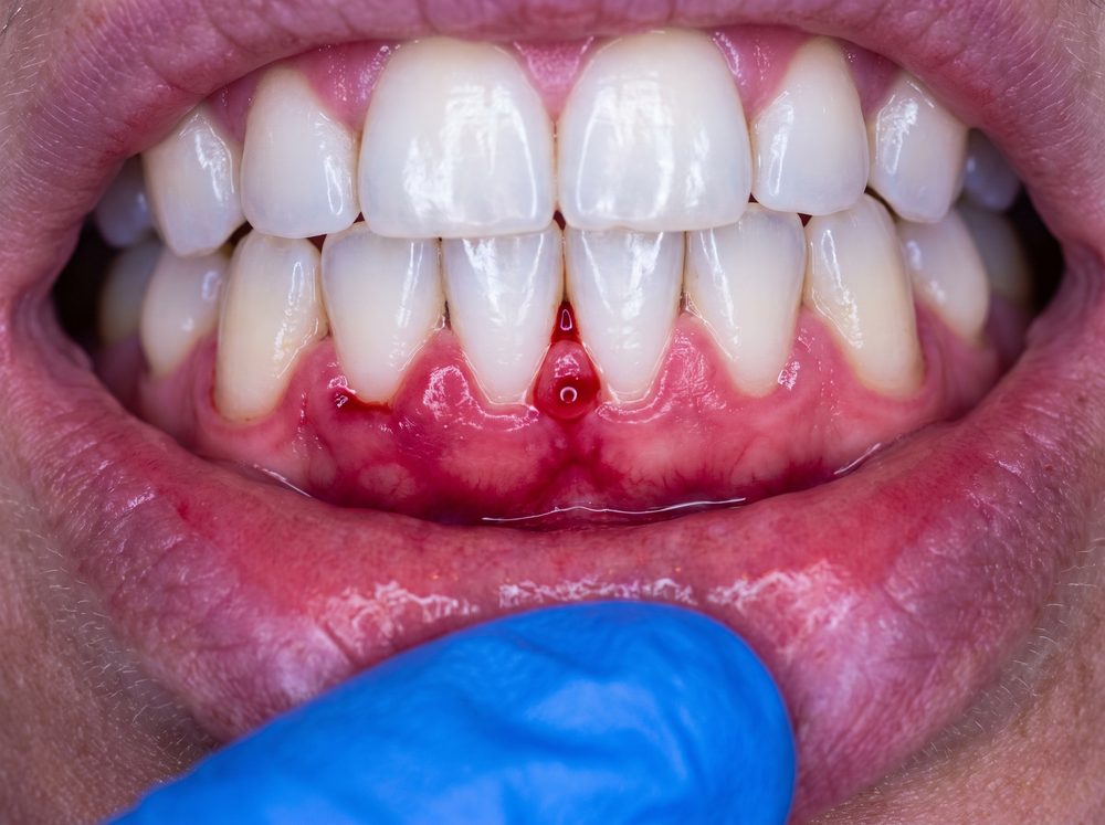 Red, swollen gums along the lower teeth